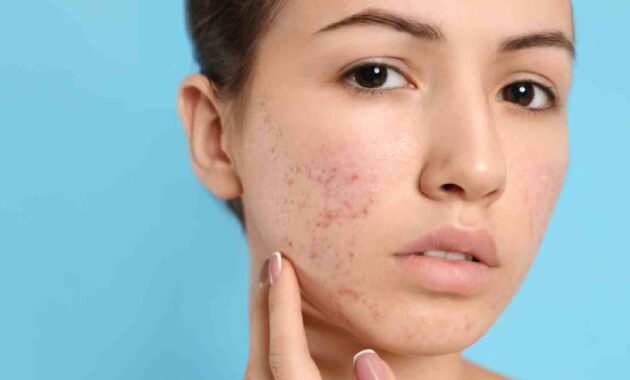 5 nutrients to avoid acne and breakouts during monsoon