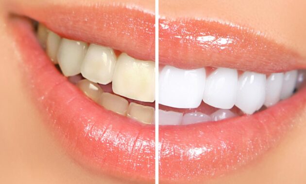 Top 5 teeth whitening products to get your brightest smile