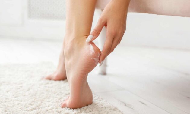 5 tips to heal cracked heels