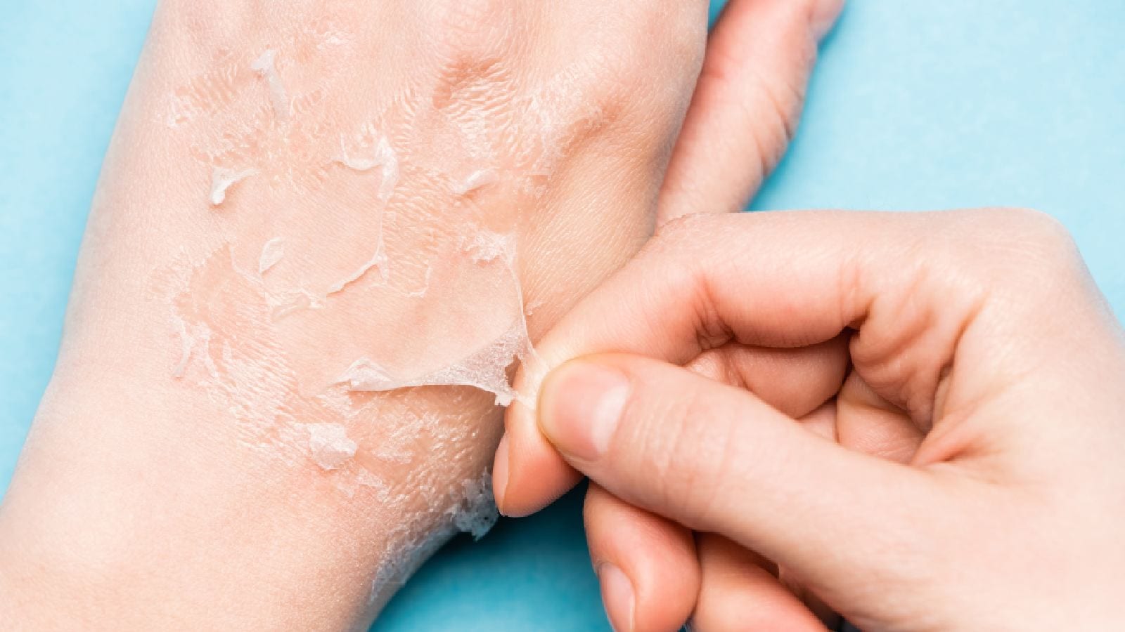 Dry peeling skin: 7 home remedies you can try