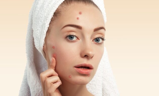 Tips to get rid of acne at home