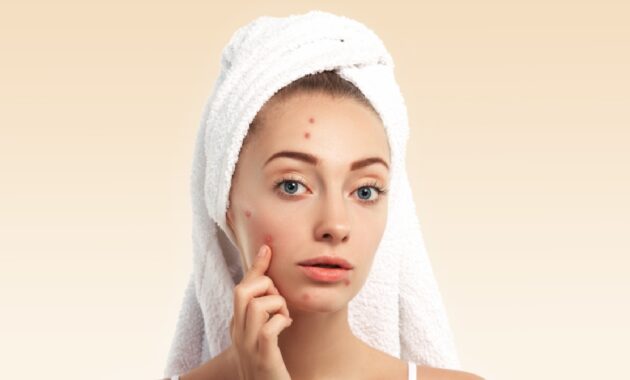 Zinc for acne: Benefits and How to use