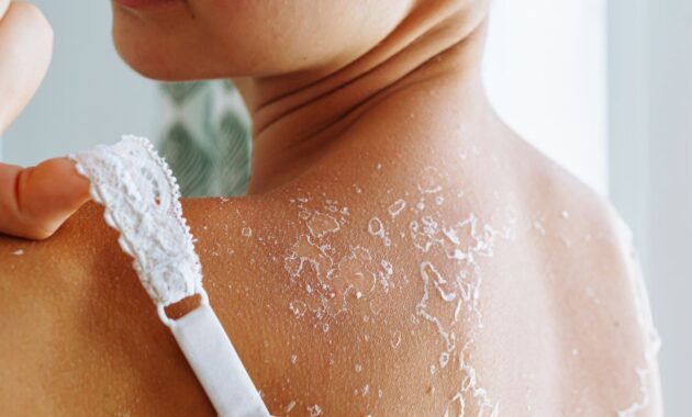 6 effective home remedies for peeling sunburn