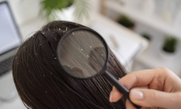 Dandruff: What is it, Causes, Treatment and Prevention Tips