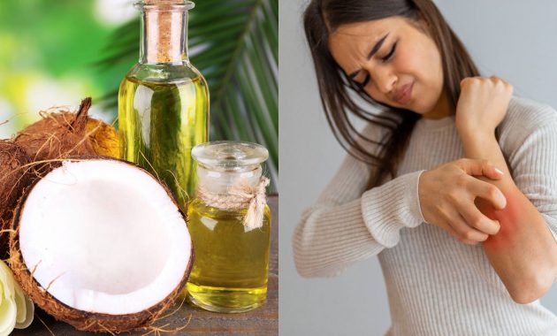 Coconut oil: Is it an effective home remedy for psoriasis?
