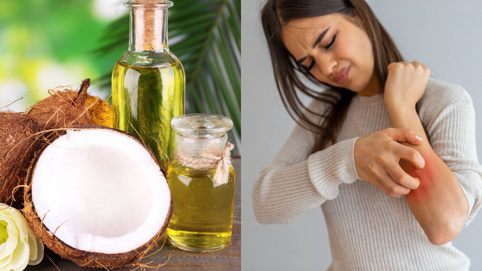 Coconut oil: Is it an effective home remedy for psoriasis?