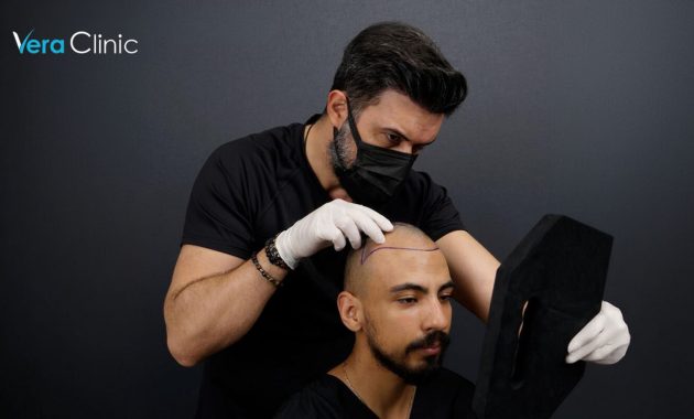 Best Hair Transplant in Turkey: A Sector Overview