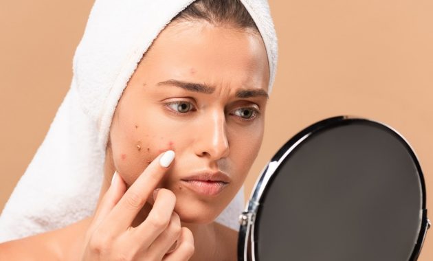 Cystic acne: How to get rid of them naturally?