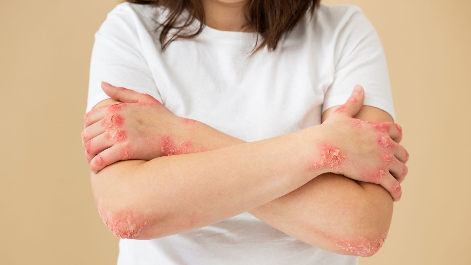 Red spots on skin: Know the causes and treatment